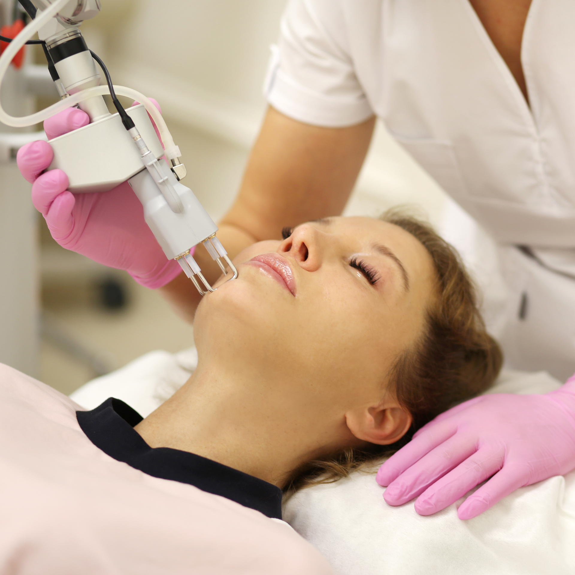 Deka Tetra CO2 laser treatment at ERA Wellness Spa