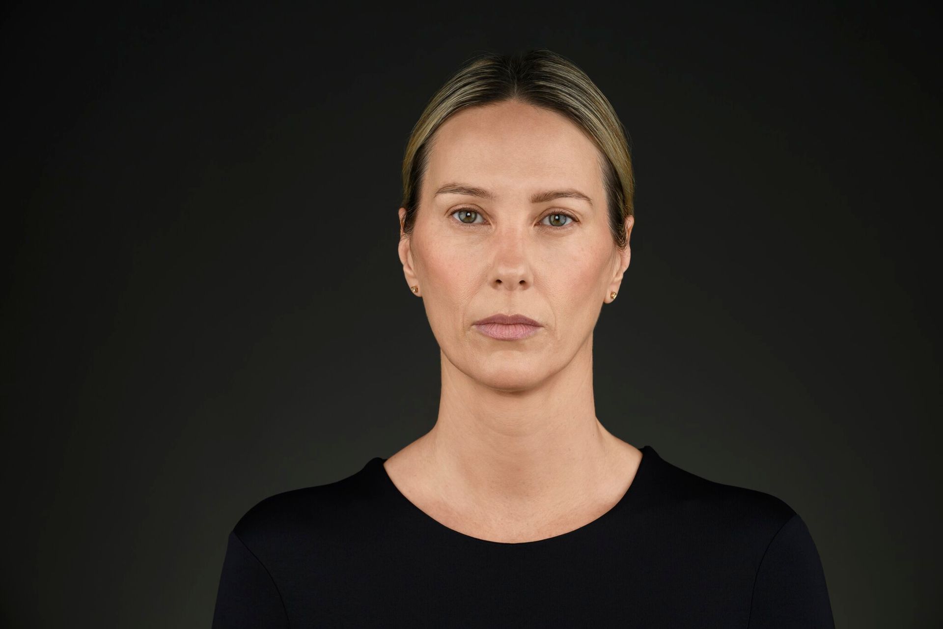 Before Evolysse dermal filler treatment at ERA Wellness Spa