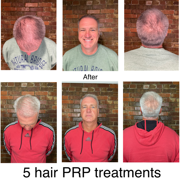 PRP Hair Before and After at ERA Wellness Spa