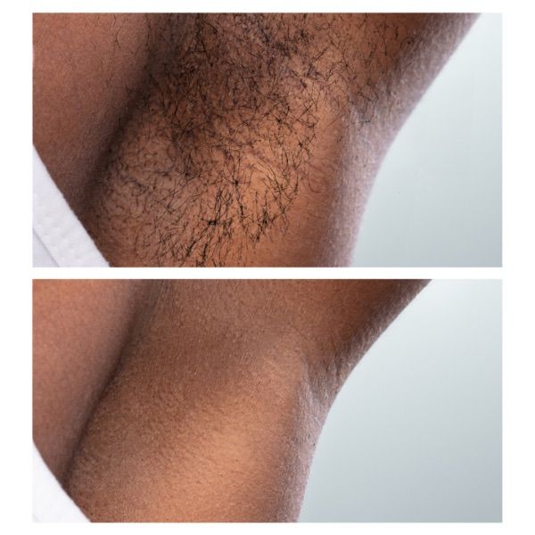 Before and after of laser hair removal in Evergreen Colorado