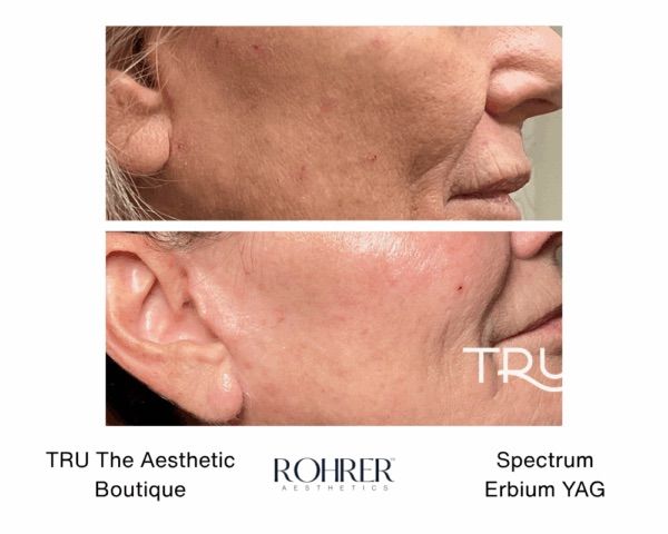 Before and after in Evergreen Colorado of laser skin resurfacing