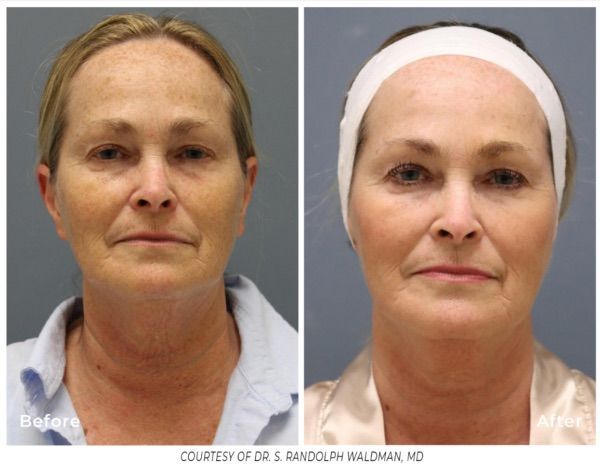 Radiofrequency Microneedling in Evergreen, Colorado