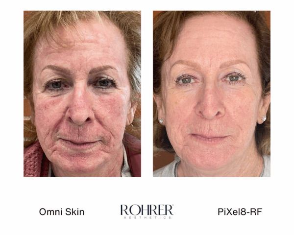 Before and after of rf microneedlingin Evergreen Colorado