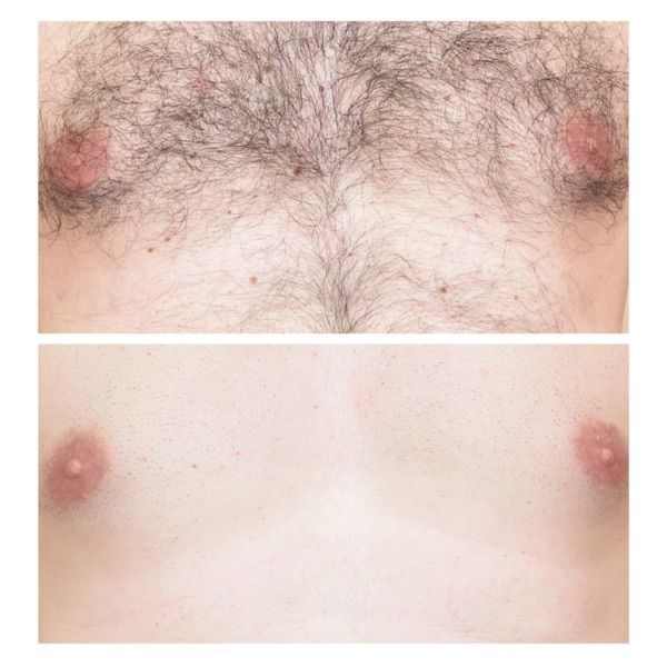 Before and after in Evergreen Colorado of laser hair removal