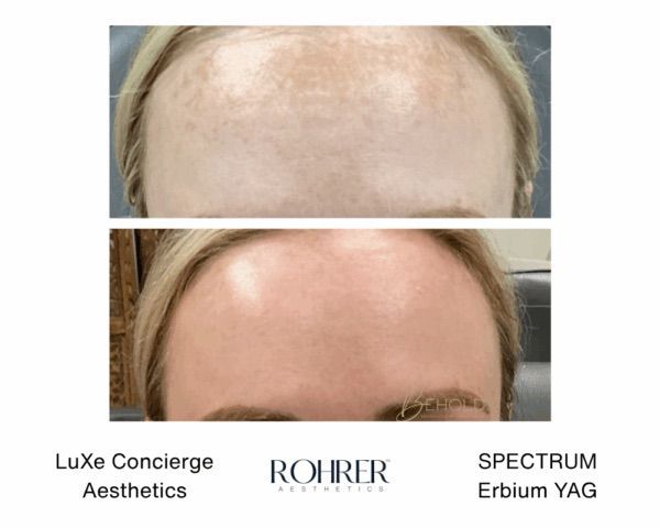 Evergreen Colorado laser skin resurfacing at Lela Skin Care and Facials