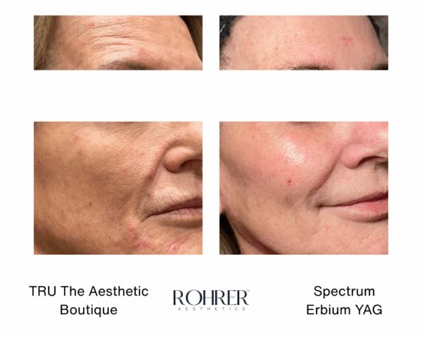 Before and after of laser skin resurfacing in Evergreen Colorado
