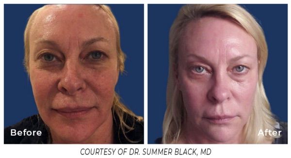 Laser Skin Resurfacing in Evergreen, Colorado at Lela Skin Care and Facials