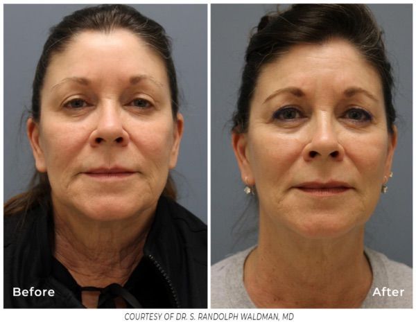 Evergreen Colorado rf microneedling at Lela Skin Care and Facials