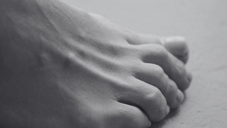 Image of claw toe deformities, a type of lesser toe deformity. Toe straightening at Ankle & Co