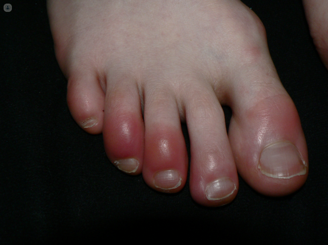 swollen toes from a foot injury