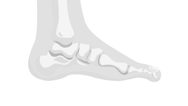 Diagram of a mallet toe, Ankle & Co.