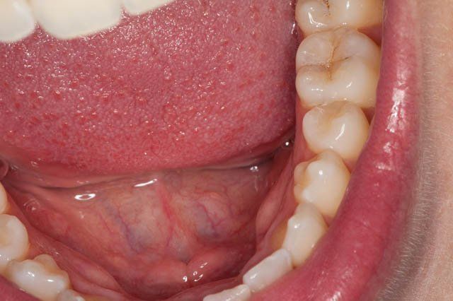 composite resin filling in open mouth