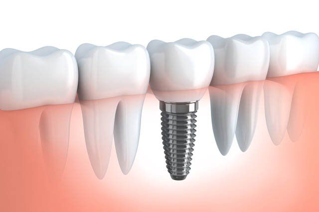 diagram of tooth implant in mouth