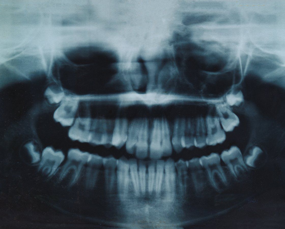 Person Dental X-ray With Wisdom Teeth — Waynesboro, GA — Burke Co. Dental