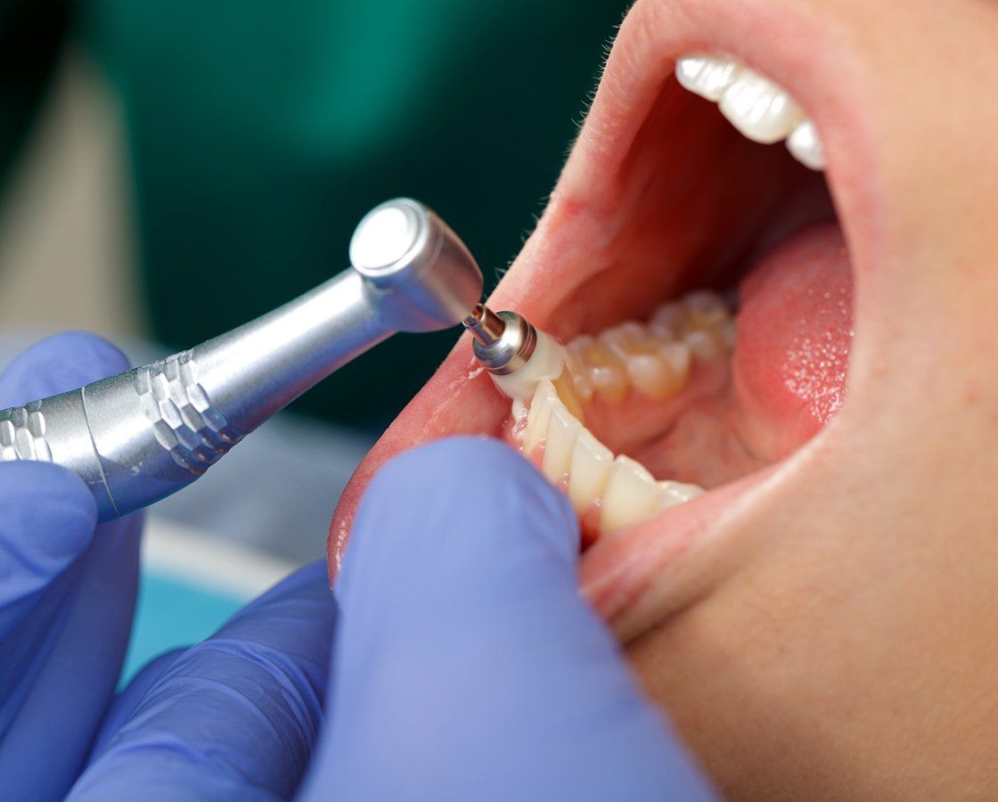 Dentist Cleaning Patient Teeth — Waynesboro, GA — Burke Co. Dental