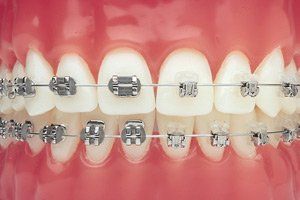 A close up of a model of a person 's teeth with braces.