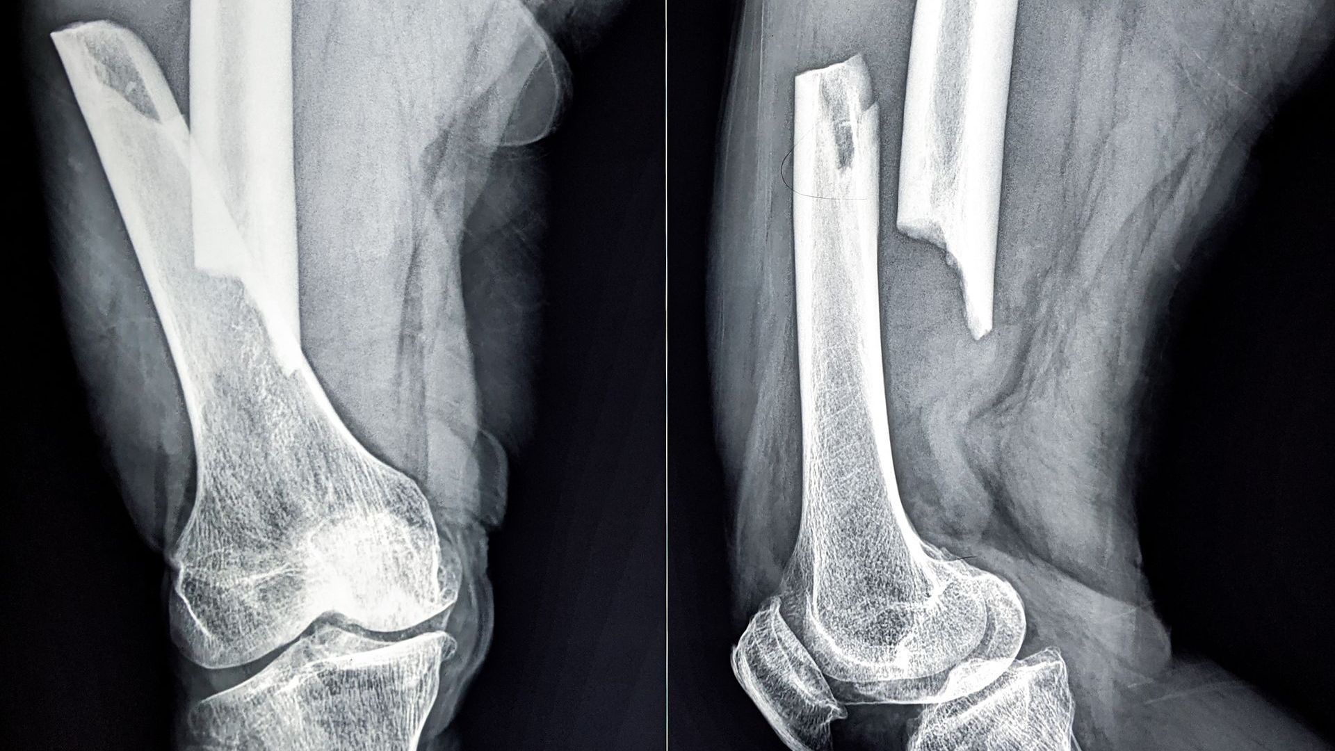 Broken bones after car accident