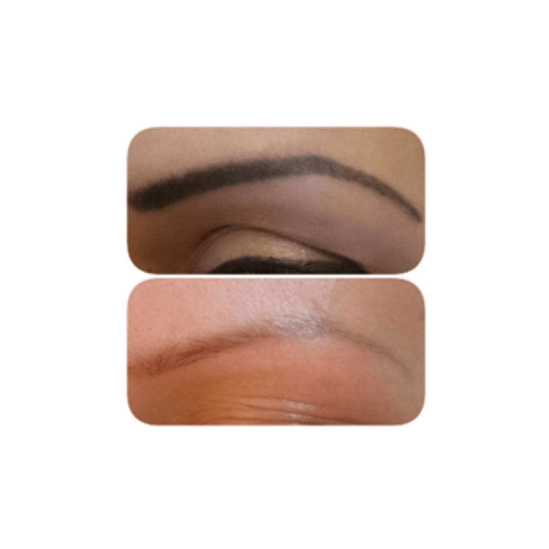 permanent make-up removal on eyebrows