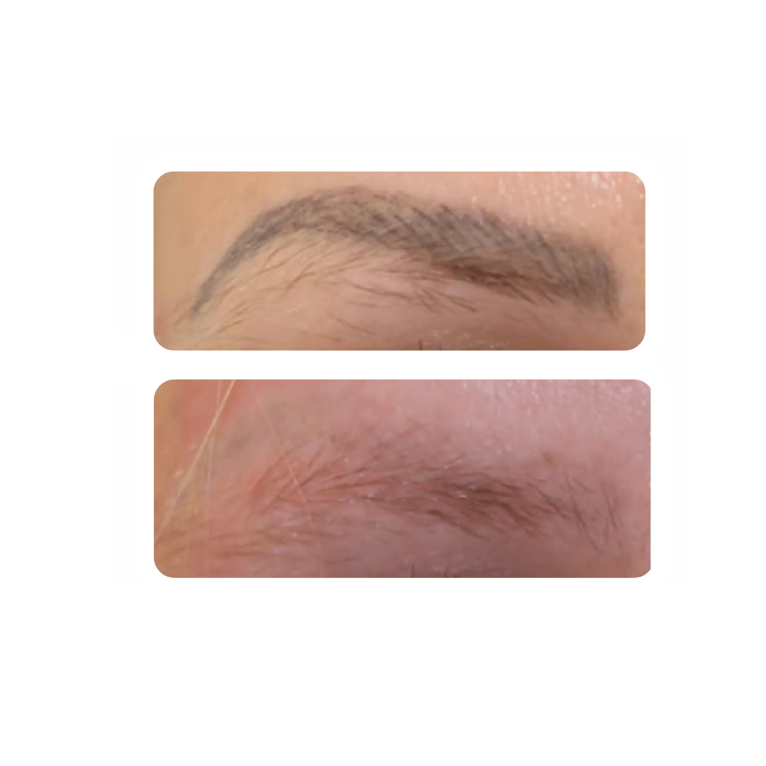 permanent make-up removal on eyebrows