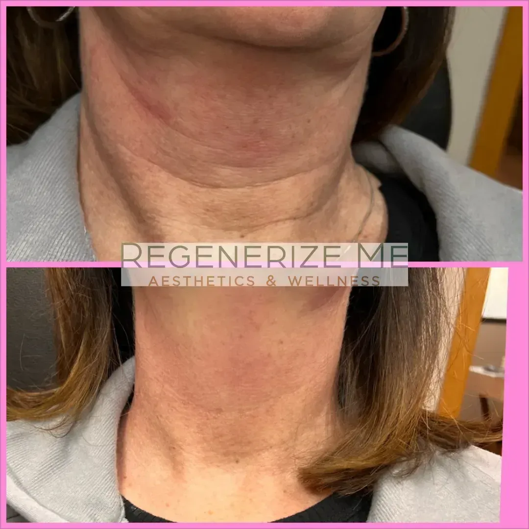 A before and after photo of a woman 's neck and neckline