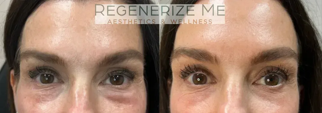 A before and after photo of a woman 's eyes.