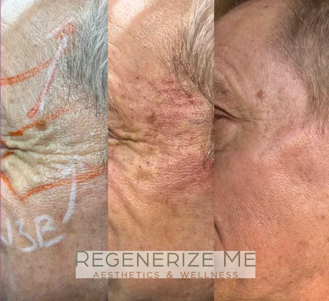 A before and after photo of an older man 's face.