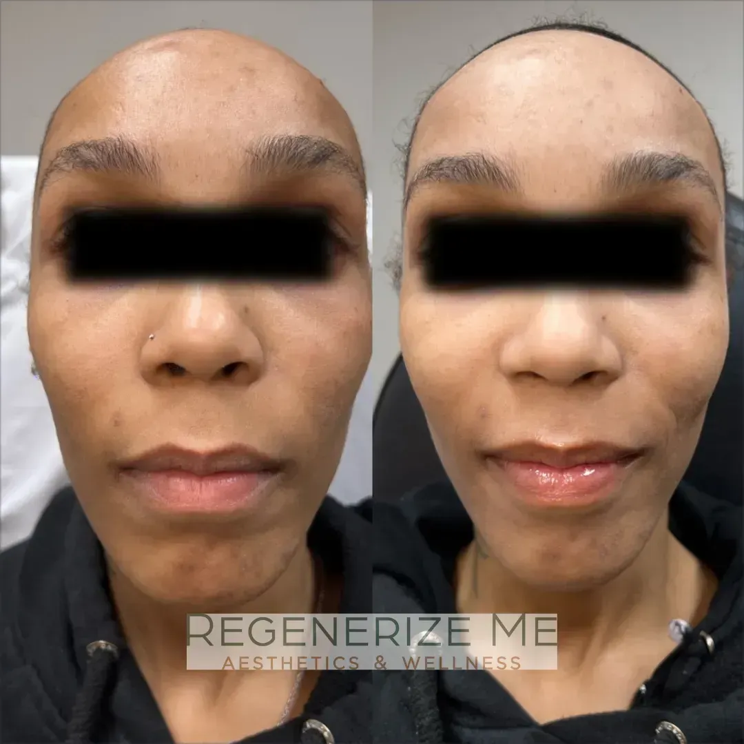 A before and after photo of a woman 's face by regenerize me aesthetics & wellness