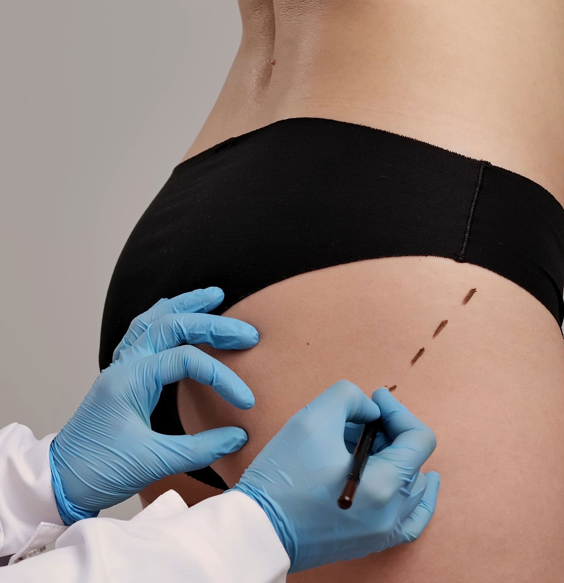 A person in blue medical gloves uses a marker to draw a dashed line on the skin of a person’s hip area.