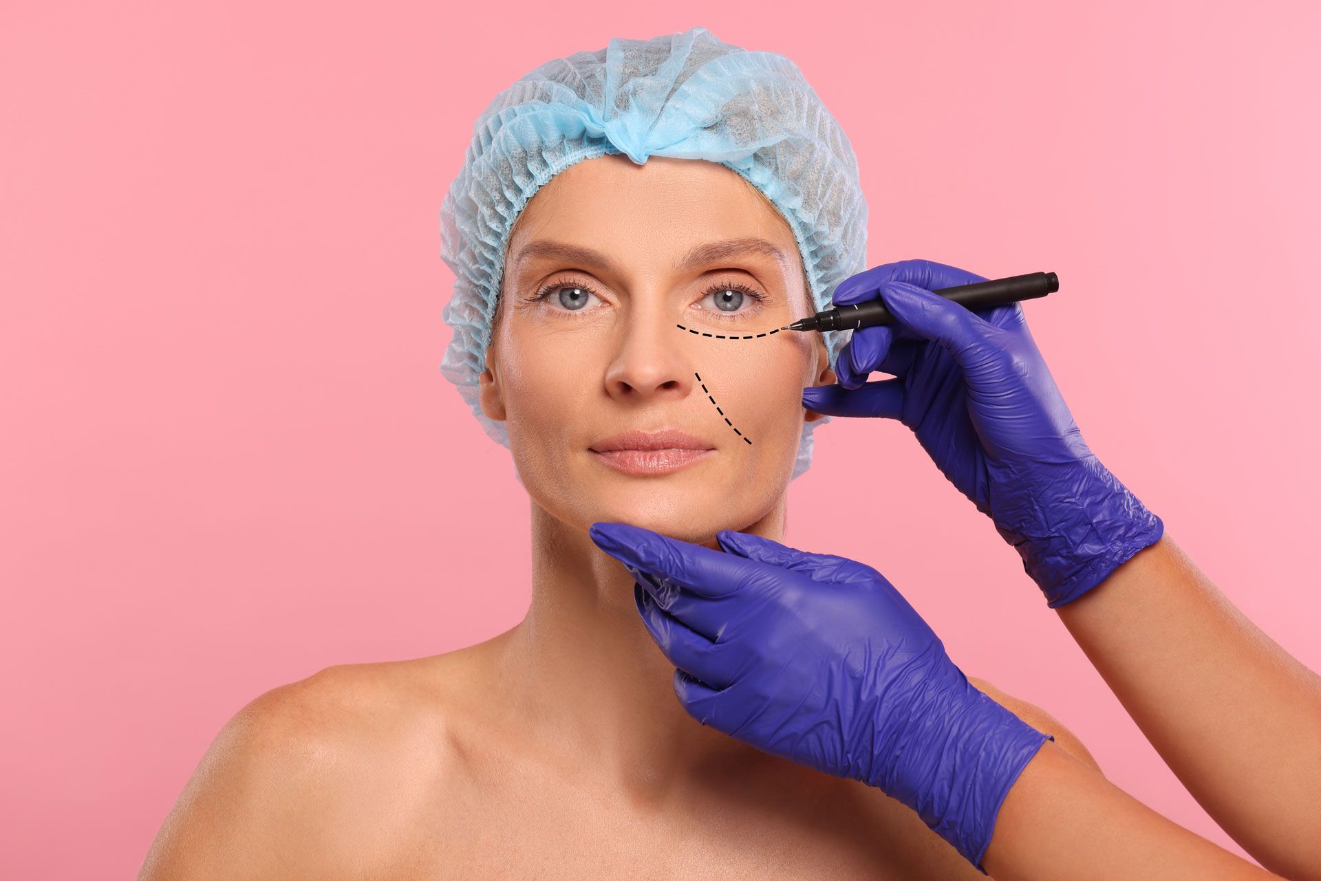 A person wearing a surgical cap has dashed lines marked on their face as a gloved hand uses a marker for plastic surgery.