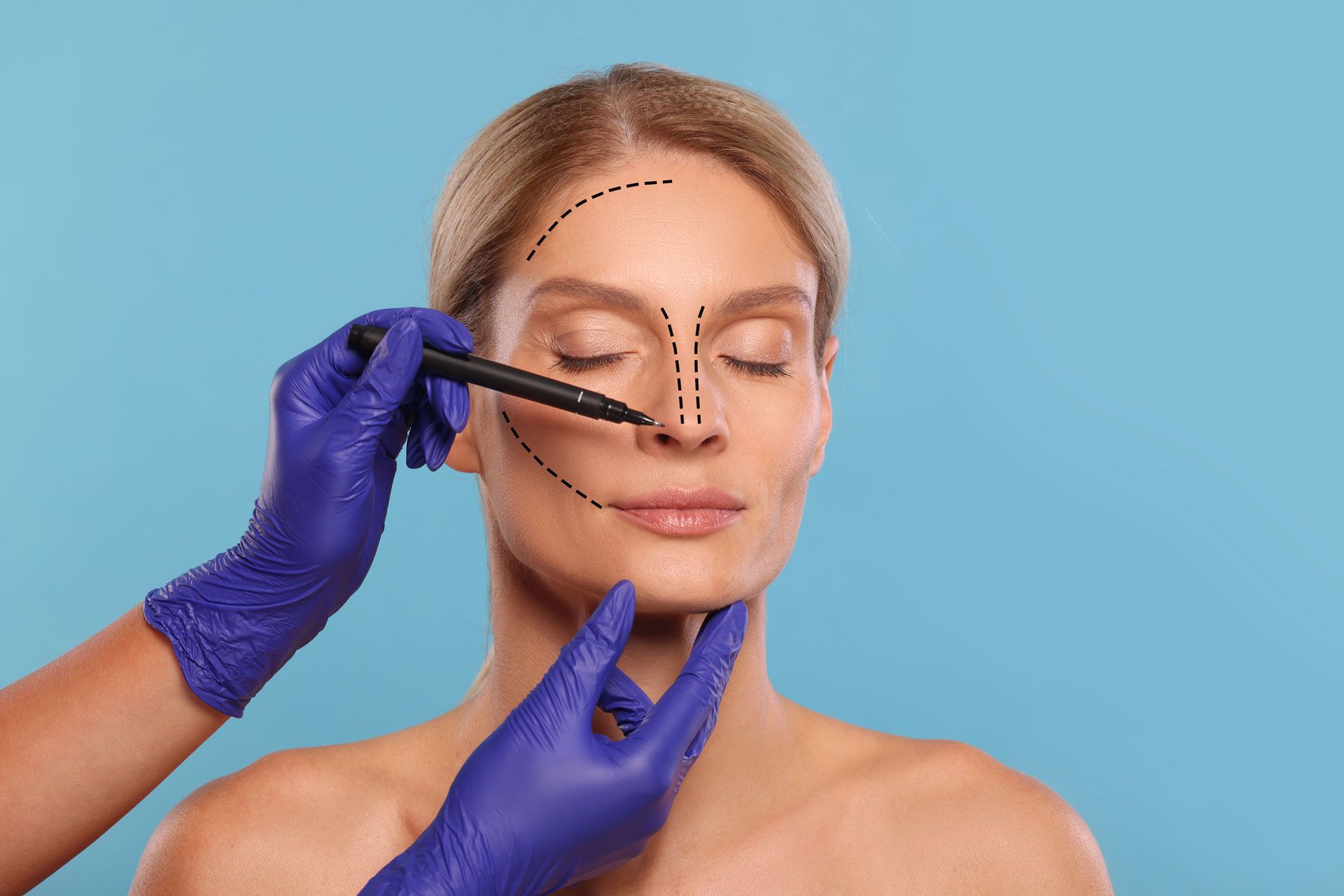 A clinician in blue gloves uses a marker to outline a patient's face for a cosmetic procedure against a blue background.
