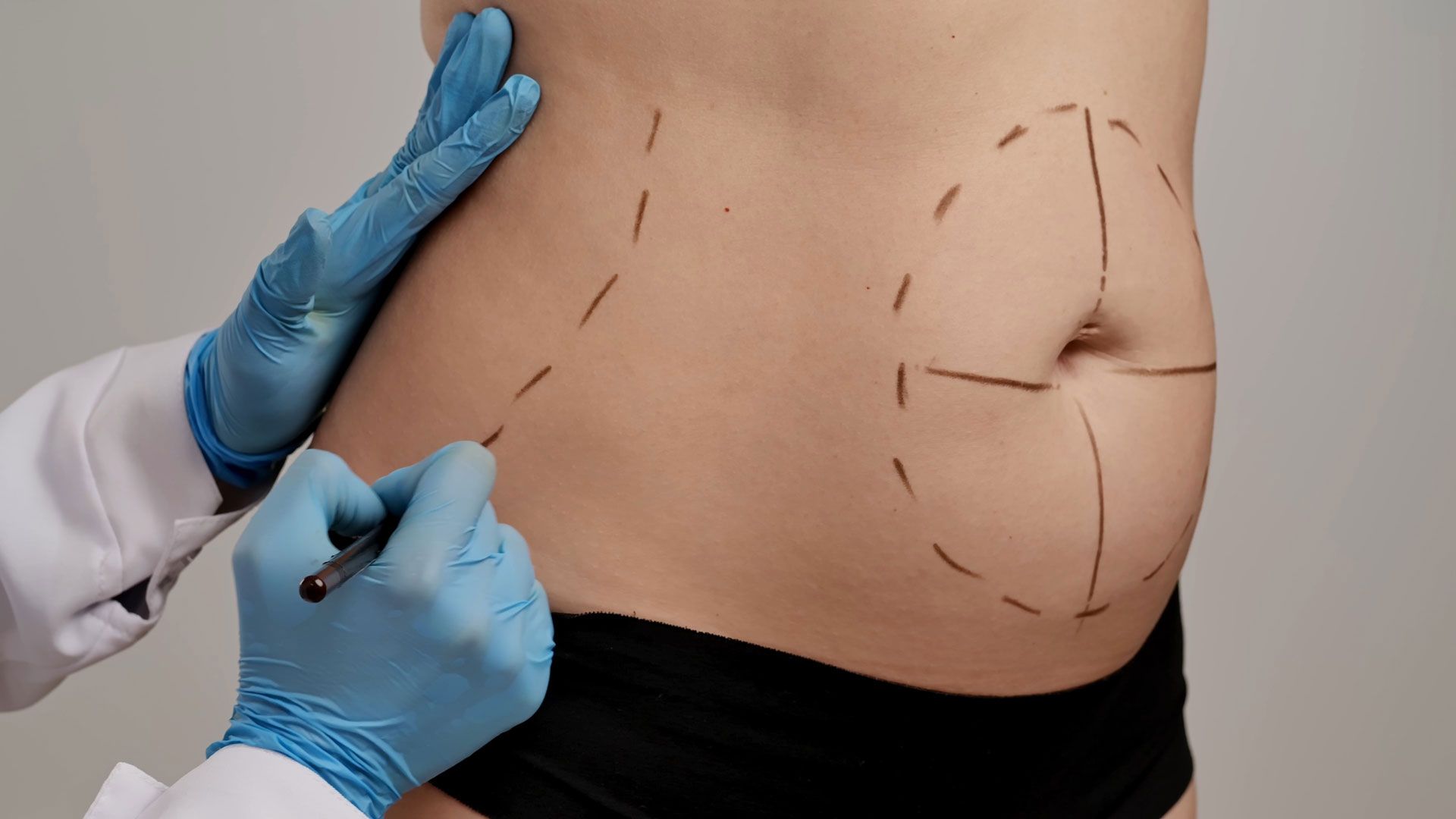 A medical professional in blue gloves marks a person's abdomen and side with a pen for a cosmetic procedure.