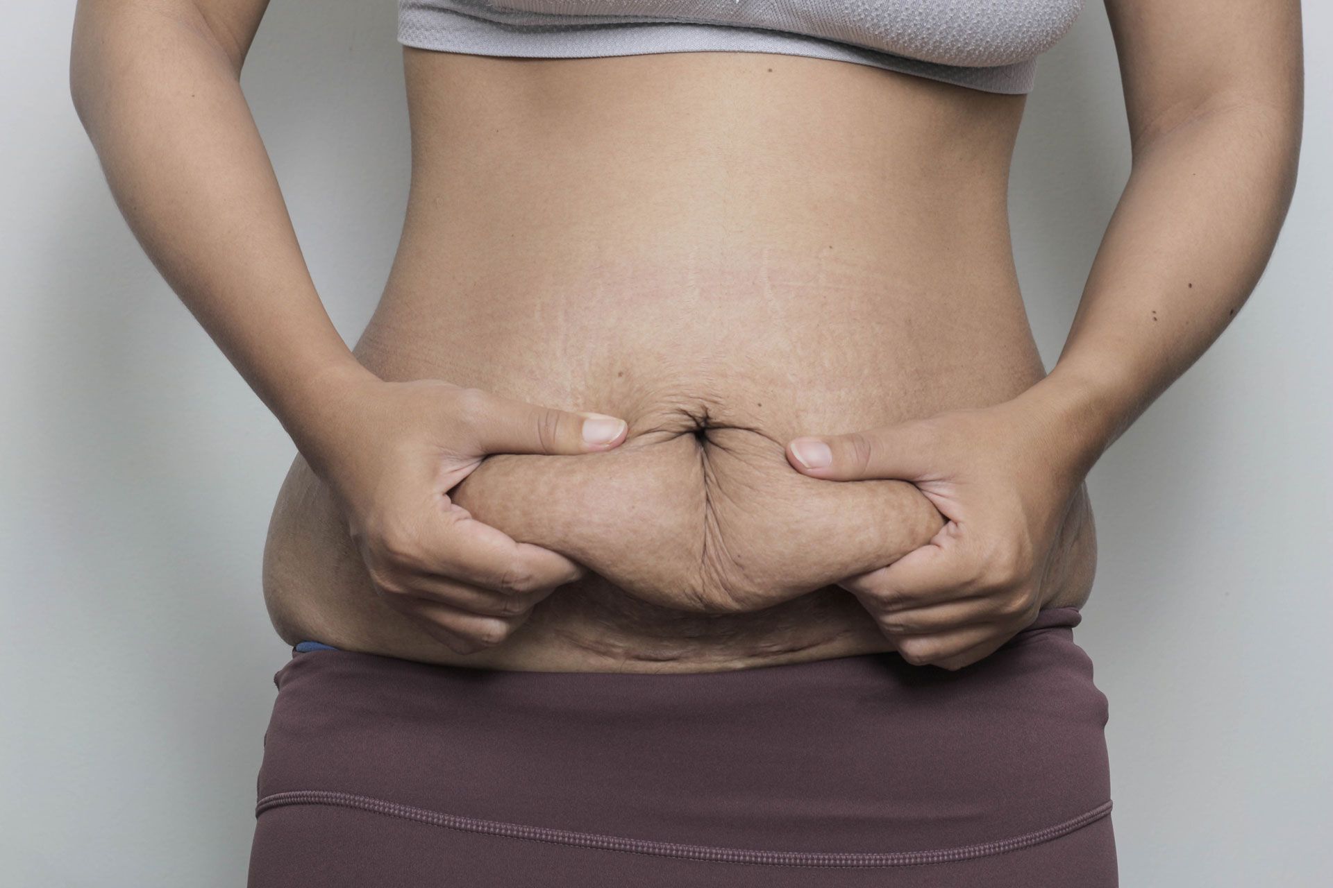 A person holds a fold of skin on their abdomen, showing visible stretch marks and a surgical scar.