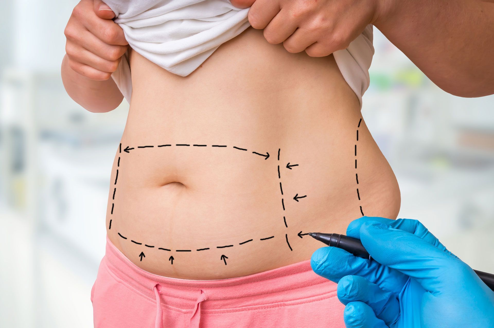 A person’s abdomen marked with dashed lines for a cosmetic procedure, with a gloved hand holding a marker.