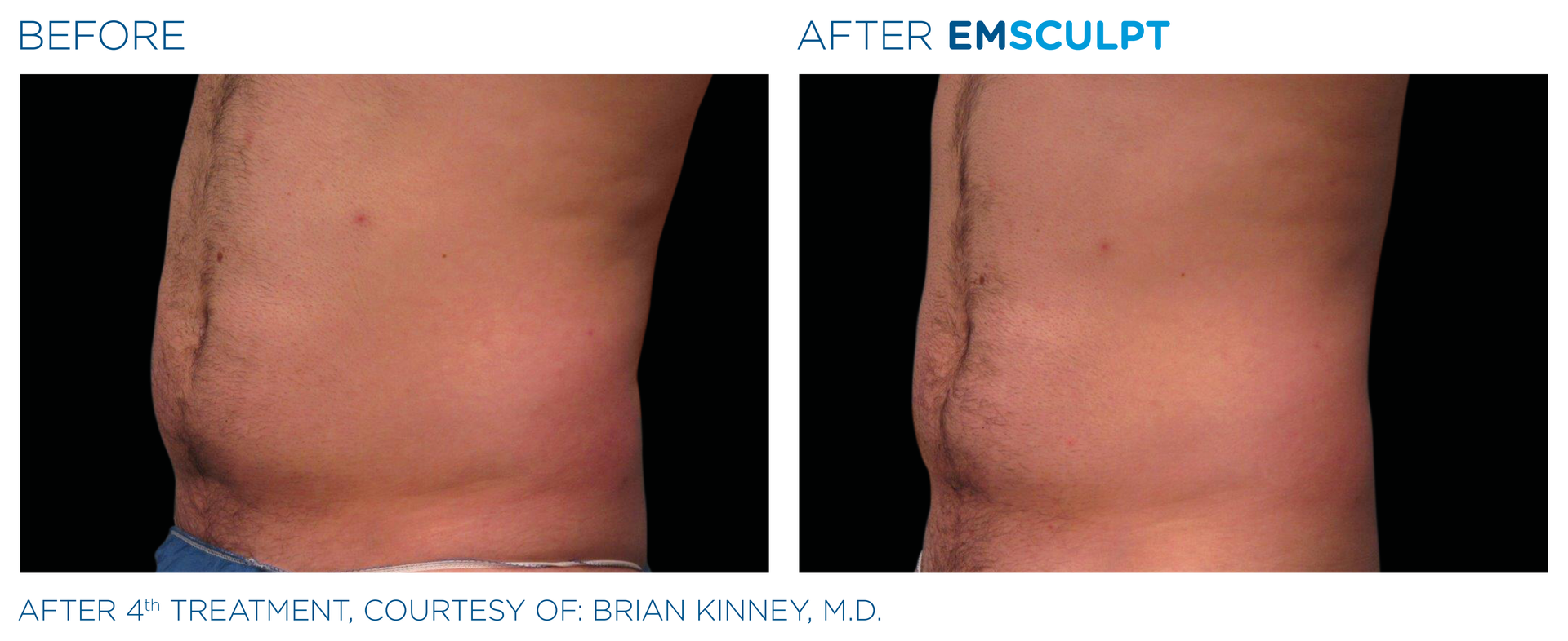 Before and After EmSclupt Therapy