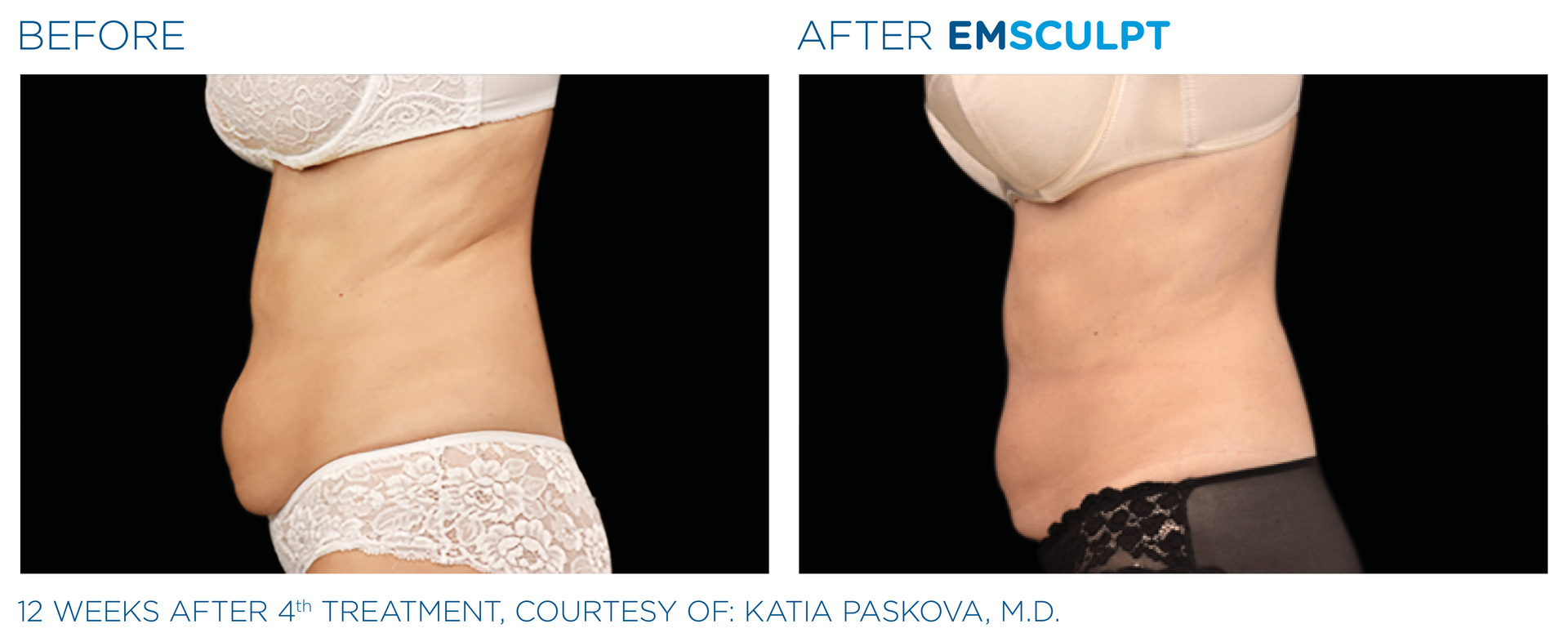 Before and After EmSclupt Procedure