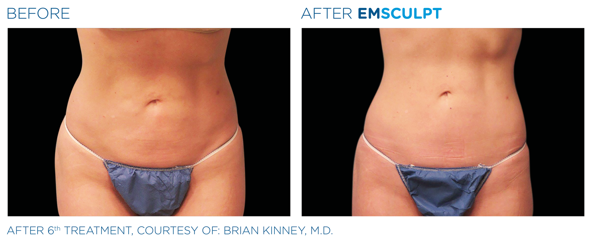 Before and After EmSclupt