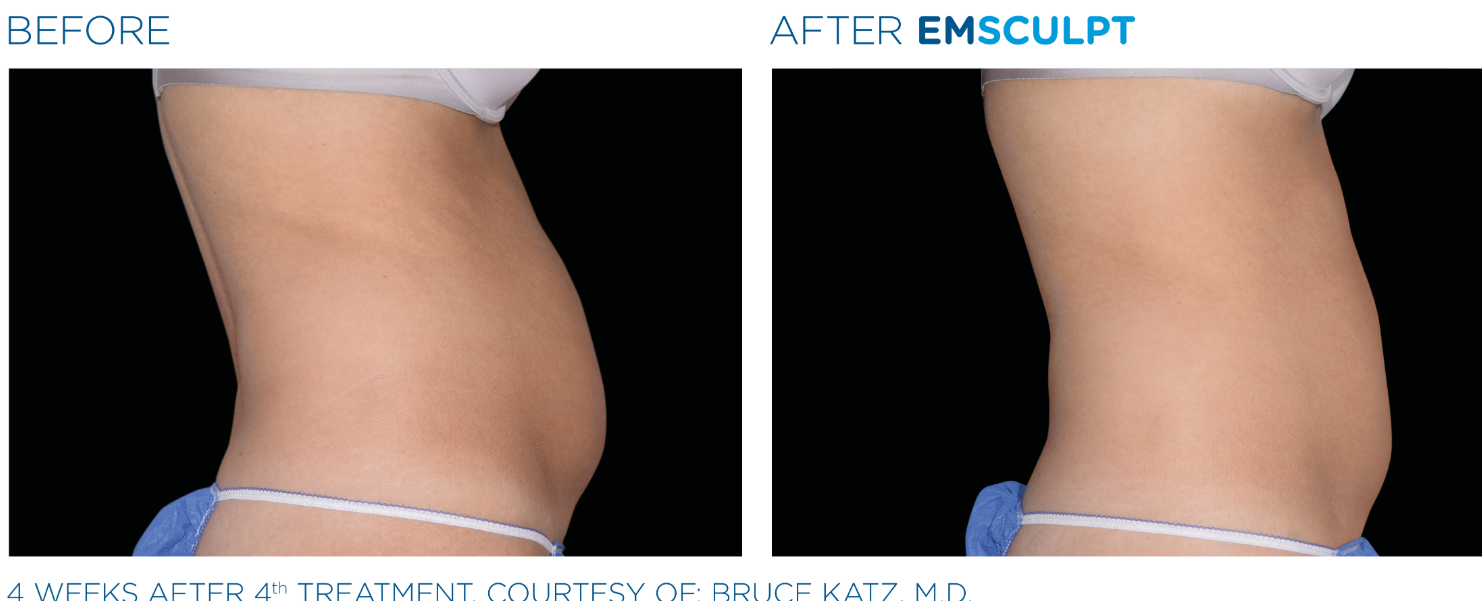 Before and After EmSclupt Procedure of the Woman