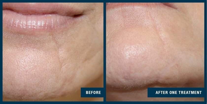 Before Microneedling on the Face