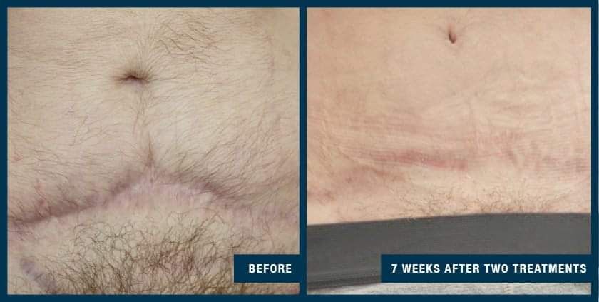 After Microneedling on the Belly