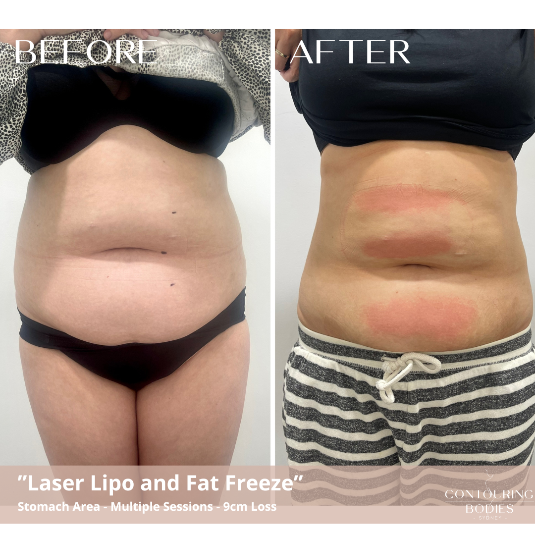 Fat Freezing Before and Afters