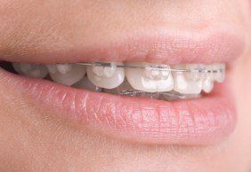 lingual braces at growing smile doctors