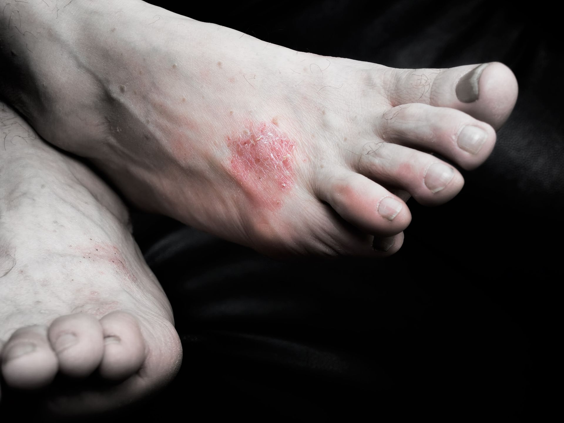 Chronic Foot Conditions