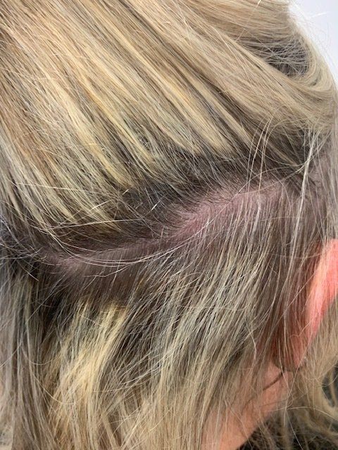 Derma rash after treatment photo by Vamp Hair Boutique in Blenheim NZ