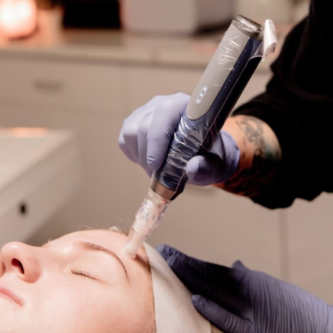 Person receiving microneedling treatment on the face. Gloved hands holding device. White headband, blue gloves.