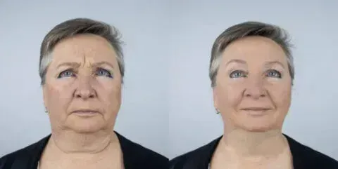 Side-by-side comparison of woman's face before and after a treatment. The woman looks up in both images.