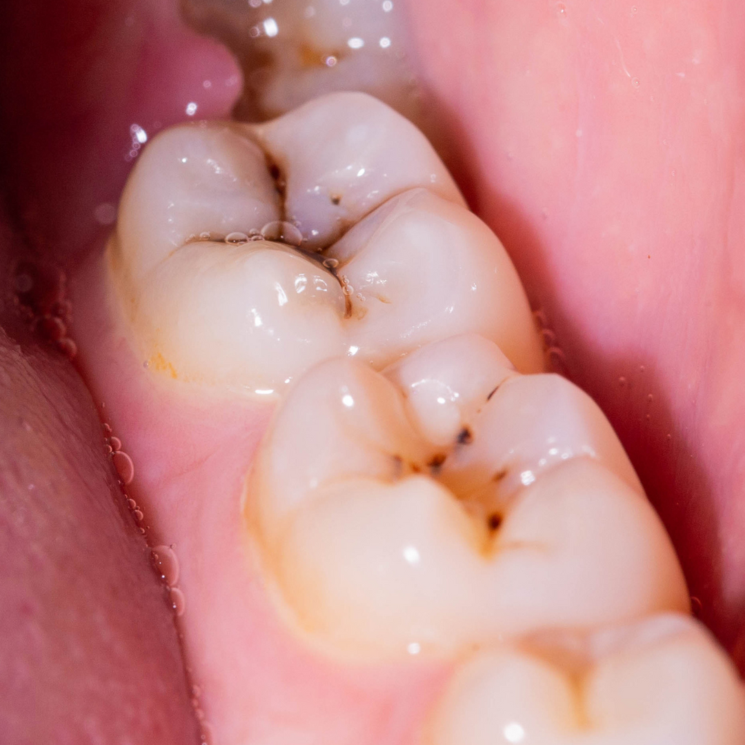 Close-up of teeth with several cavities visible in the molars.