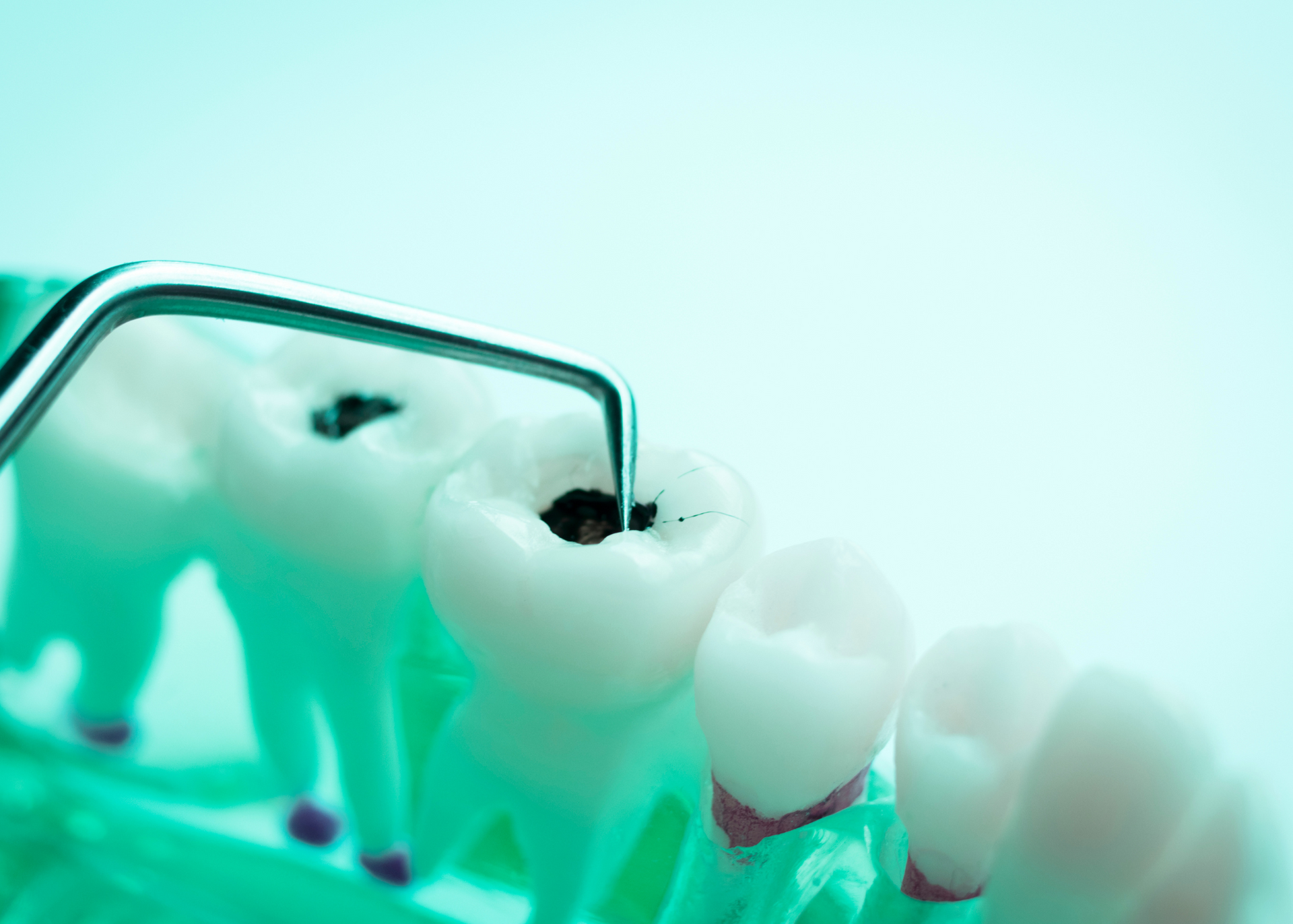 Dental model with probe examining a tooth cavity.