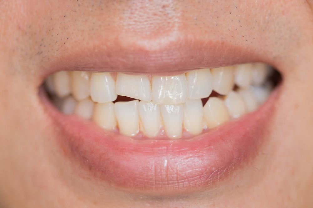 Close-up of a smiling mouth, showing teeth with slight yellowing and a small gap between the front two.