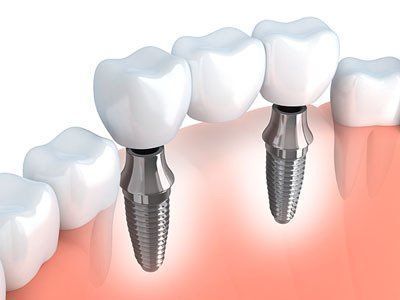 Dental implants supporting a bridge of three artificial teeth; viewed inside the mouth.