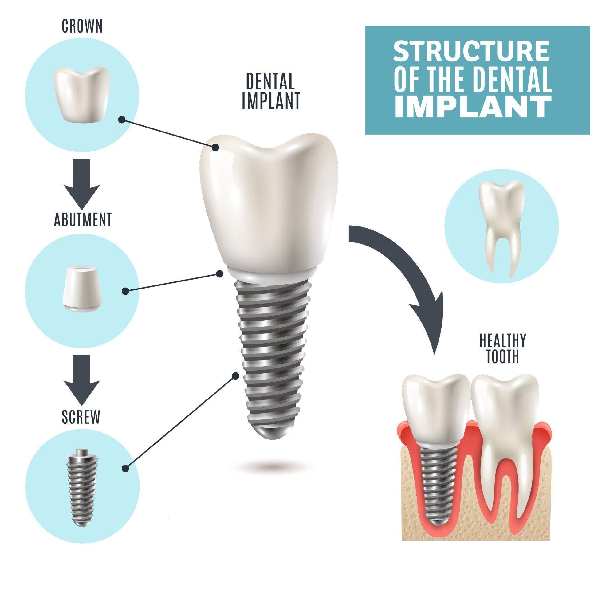 Diagram of a dental implant showing crown, abutment, screw components and a healthy tooth example.